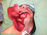 cheek folded up during surgery for removal of squamous cell cancer