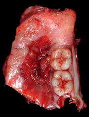 section containing sqamous cell carcinoma