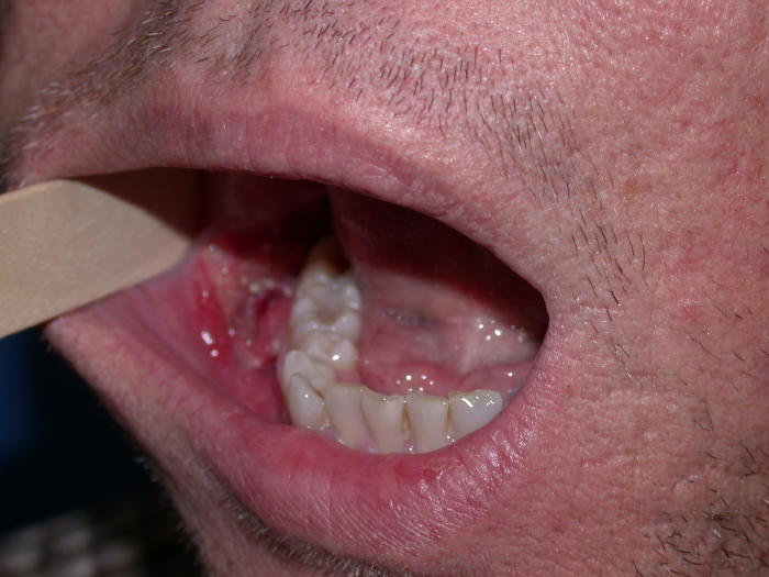 lip cancer from chewing